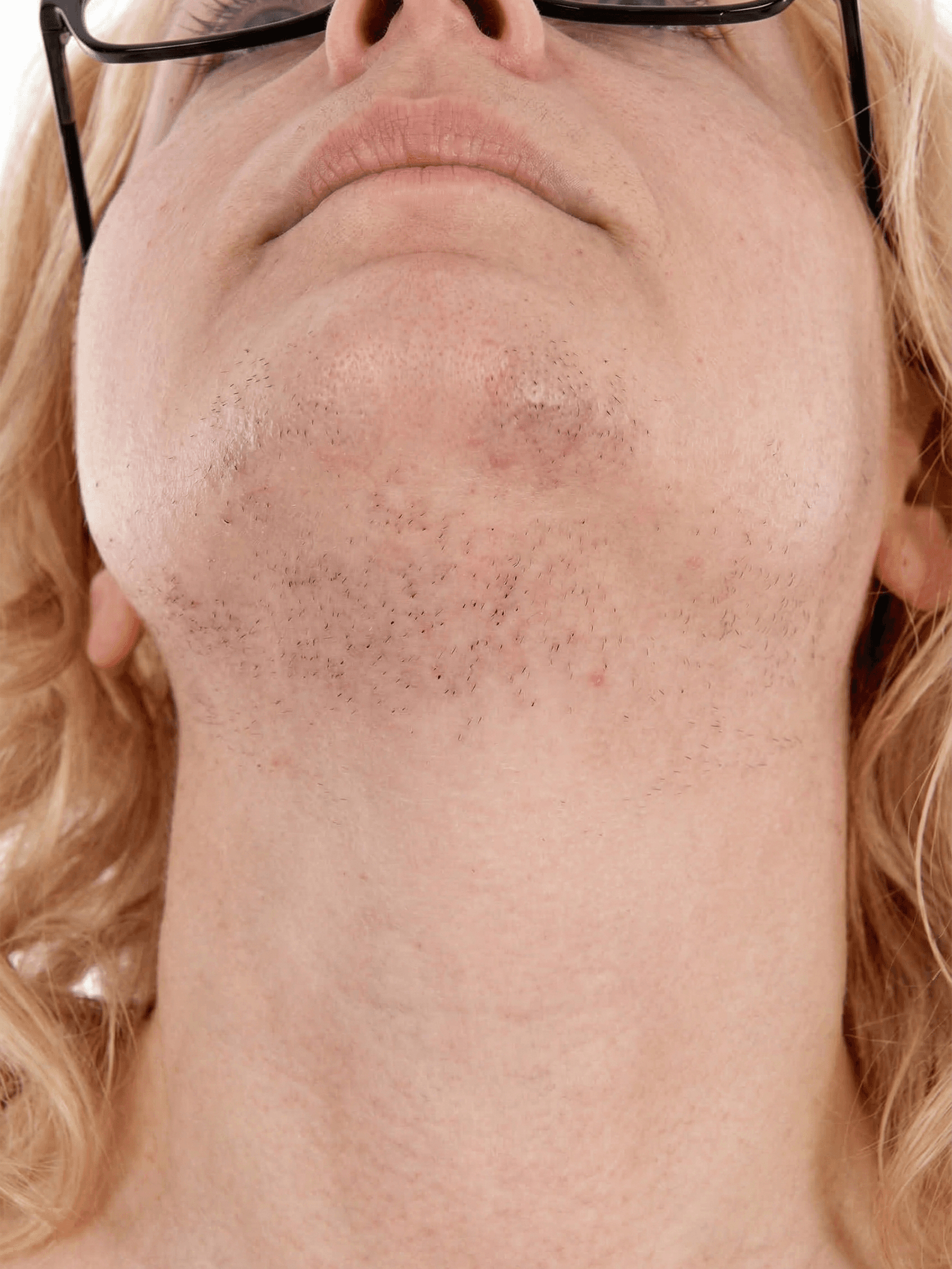 Polikistikover - Rahim ve Yumurtalık Sağlığı